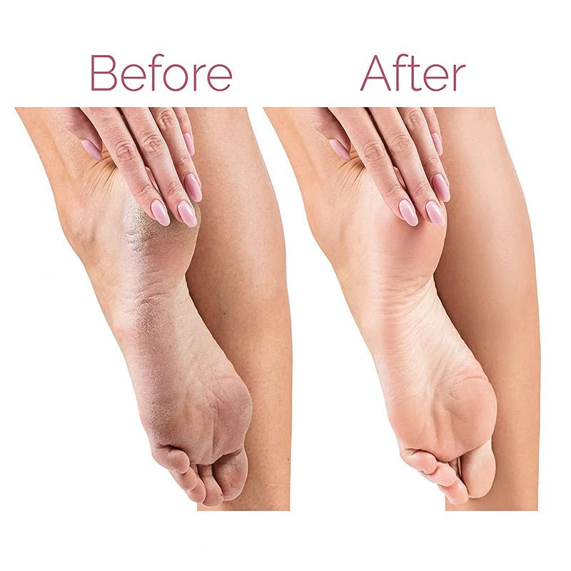 Electric Callus Remover for Feet, Electric Grinder for Foot File and Nail, Electronic Tool File and Callus Remover, Pedicure-New Version