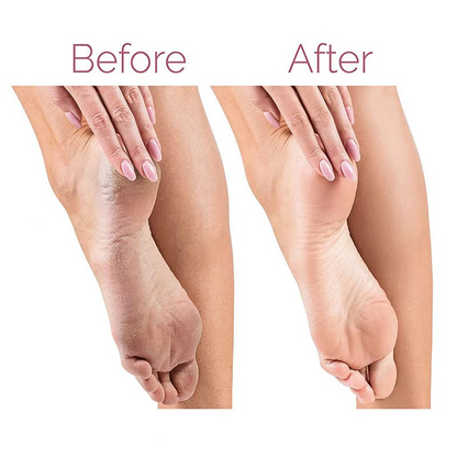 Electric Callus Remover for Feet, Electric Grinder for Foot File and Nail, Electronic Tool File and Callus Remover, Pedicure-New Version