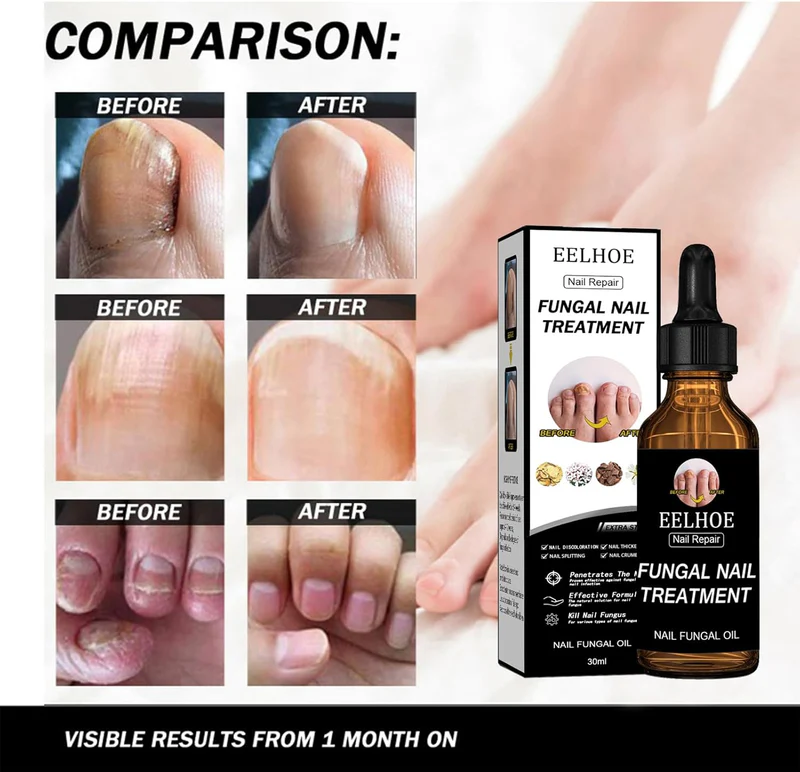 EELHOE - Nail Repair Fungal Oil