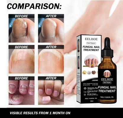 EELHOE - Nail Repair Fungal Oil